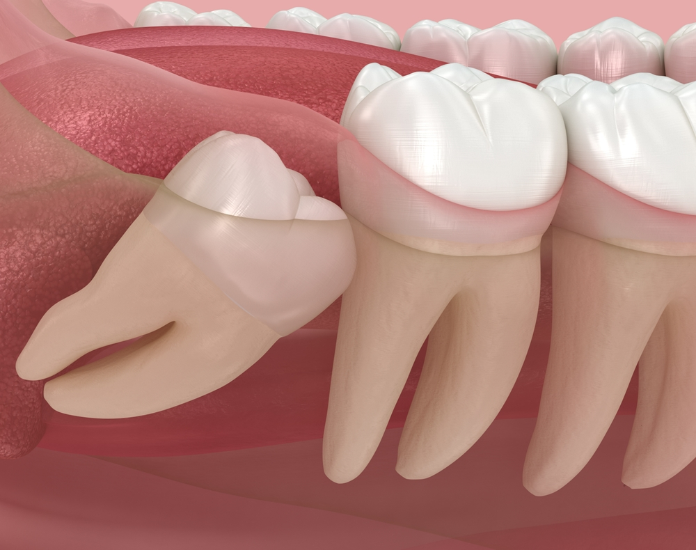 Wisdom Tooth Removal
