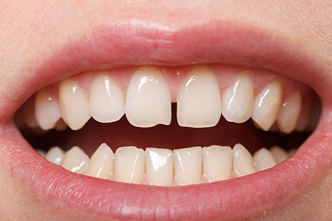 Treating Gaps and Spacing Issues