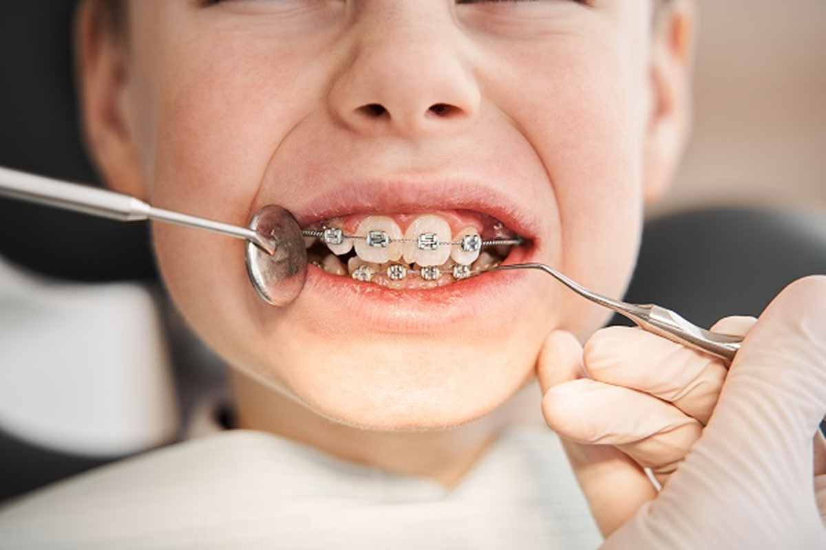 Relapse After Braces