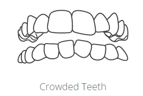 crowded teeth