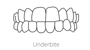 Underbite