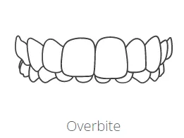 overbite