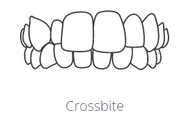 crossbite