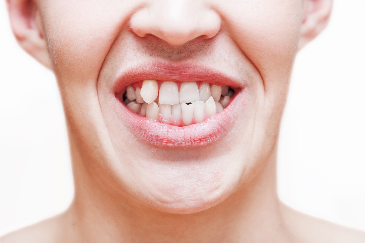 Broken or Chipped Teeth Repair