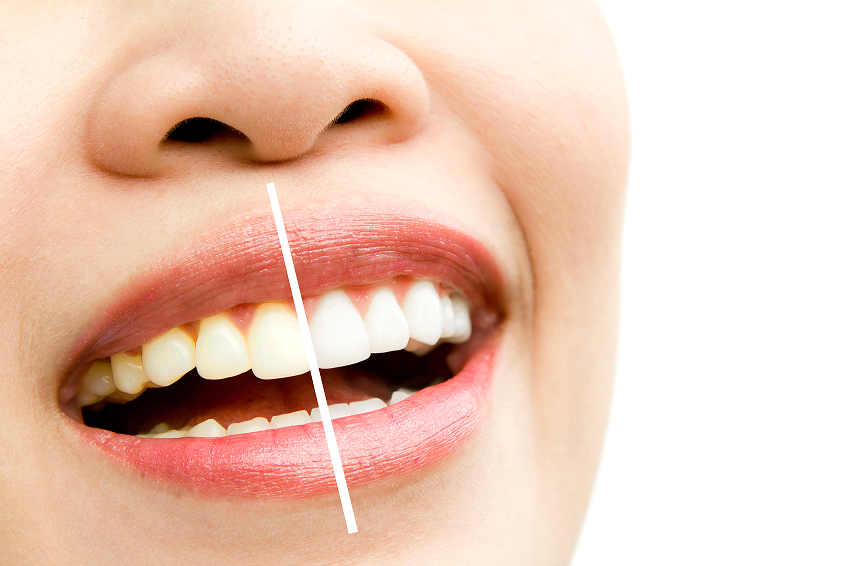 In-Clinic Whitening
